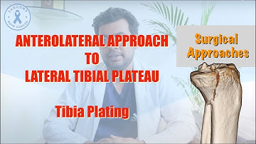 Anterolateral Approach to the Lateral Tibial Plateau | A step by step guide | Dr Deepak Garg