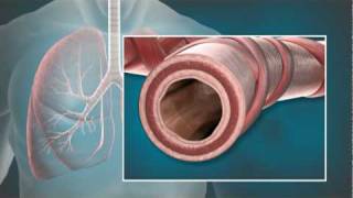 Animation of Bronchial Thermoplasty (BT) with the Alair® System