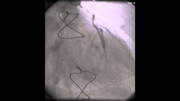 LIMA GRAFT TO LAD after 20 years