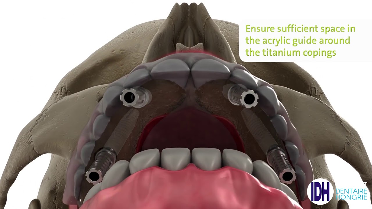 Prothèse dentaire fixe sur implants : comment retrouver ses dents aux meilleures qualités