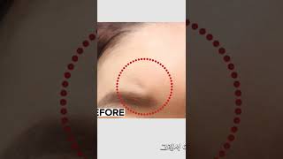 이마 지방이식후 울퉁불퉁. 모양 불만족#지방이식후 제거 가능#큐오필앤결