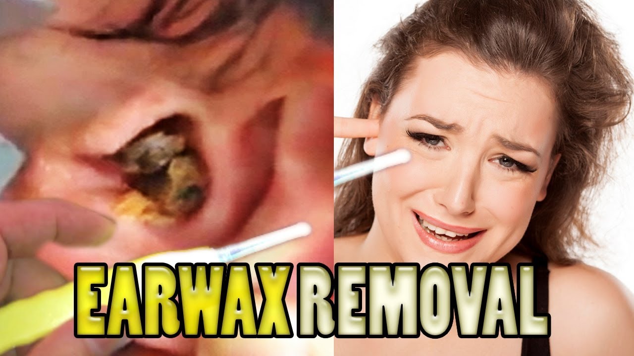 MASSIVE EARWAX REMOVAL! Pt 2 (Dr. Popper Featuring Jennifer "My Wife