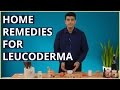 3 Best LEUCODERMA (VITILIGO) Treatments At Home With Natural Remedies