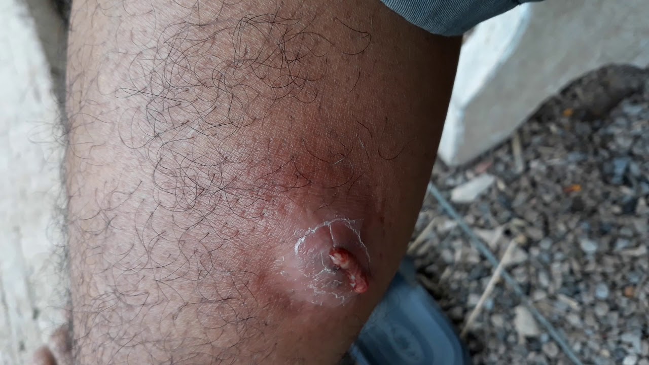 Opening the big cyst on the leg