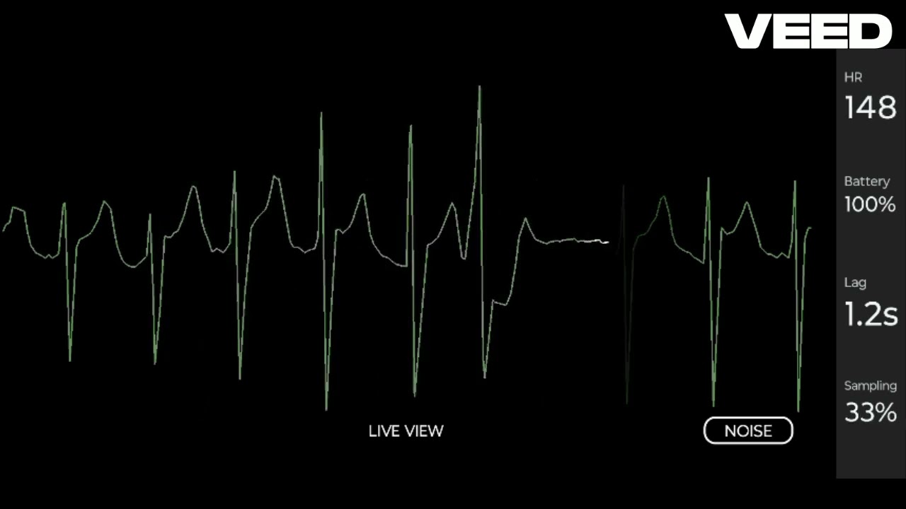 Girl´s very irregular heartbeat with ecg (reupload Heartgirl)