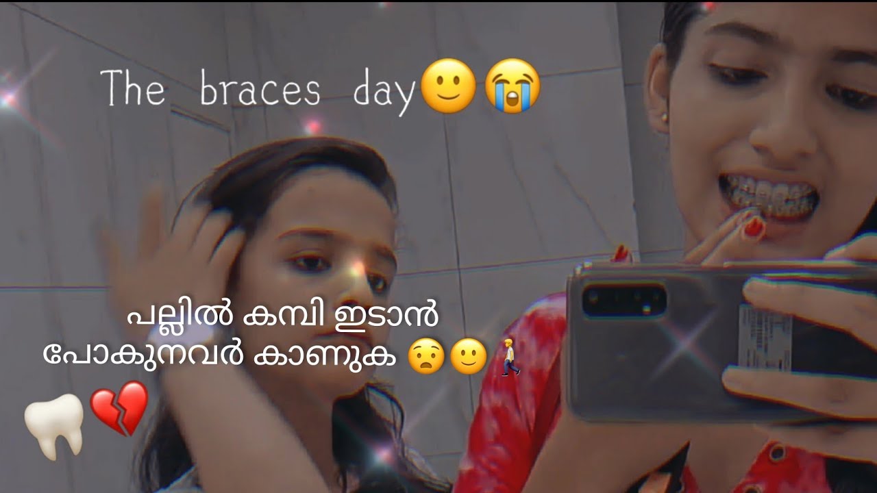 Braces Vlog video in MalayalamGETTING BRACES ON VLOG!1.0 pallii kambi