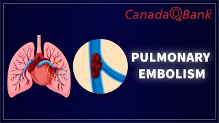 Pulmonary Embolism by CanadaQBank 1,560 views 3 months ago 7 minutes, 16 seconds