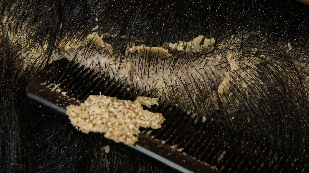 Satisfying Scalp Dandruff Removal: Comb Scratching Big Flakes #DKMOR2717