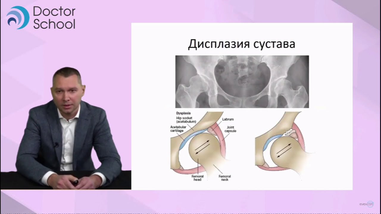 Коксартроз этиология, патогенез, факторы риска, эпидемиология, клиника, диагностика, лечение