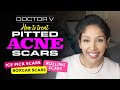 Dr V - How To Treat Pitted Acne Scars | Brown/ Black skin | Skin of colour | dehydrated skin