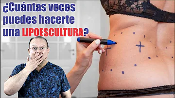 ¿Se puede hacer una liposucción dos veces?