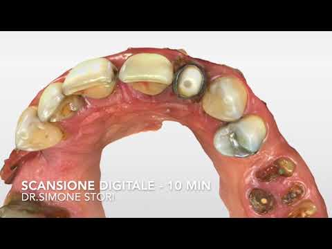 Video: Come Riparare una Corona Dentale Persa: 15 Passaggi (Illustrato)