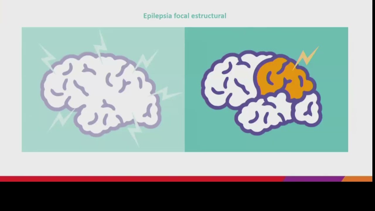 Tiempo es cerebro: La importancia de una cirugía de epilepsia precoz