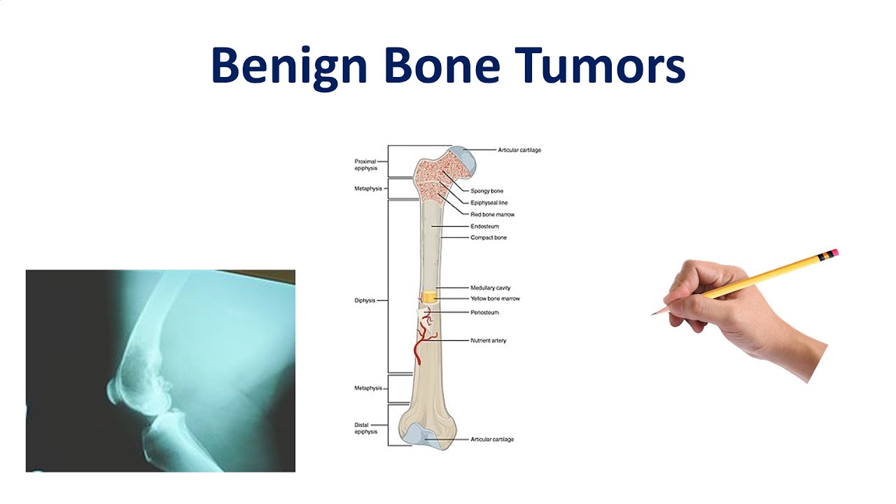 benign cancer of bone