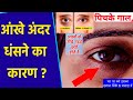 Erase Sunken Eyes at Home in a Flash! आंखों के नीचे गड्ढे,धंसी हुई आंखों का घर पर इलाज