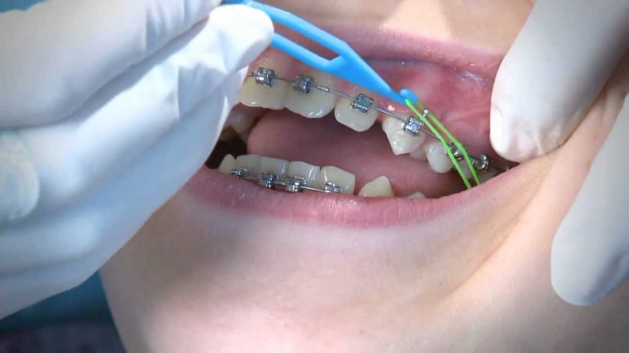 Learning the Basics About Rubber Bands on Braces