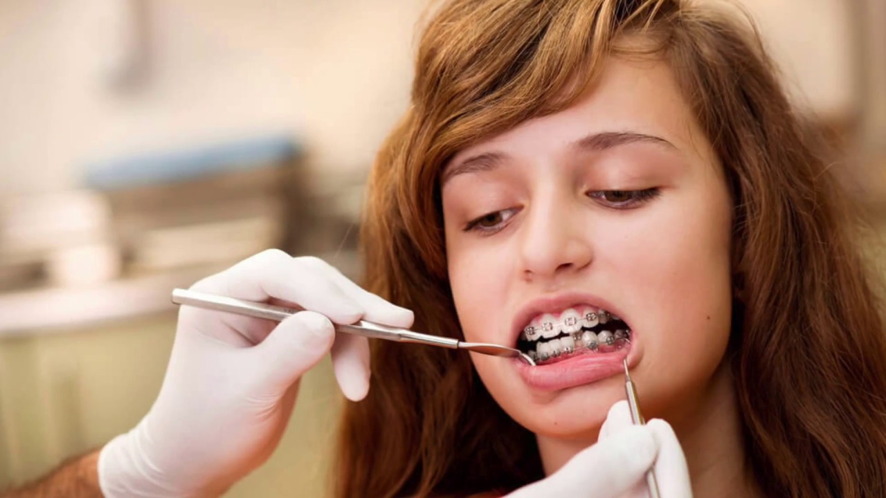 Девушка с брекетами чистит зубы эстетика. Болят зубы от брекетов что делать. Обезболивающее от зубной боли от брекетов. Болят зубы от брекетов что делать. Брекеты на зубы ортодонтия.