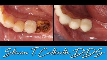 Sectioning and Extraction of Mandibular Molar; Grafting with PRF - with Steven T. Cutbirth, DDS