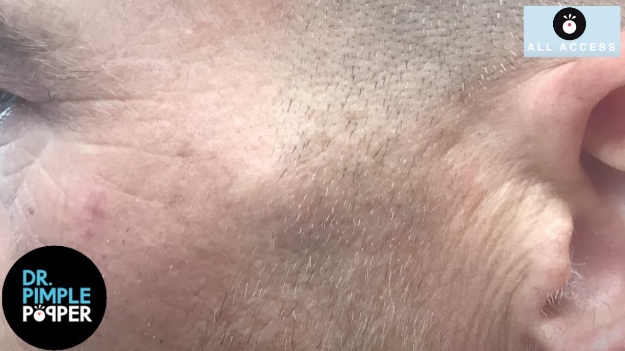 Grapes Growing Out of Head? Dr Pimple Popper Pops Face Cluster YouTube