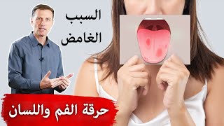 الحرقة والألم الغامض في الفم واللسان