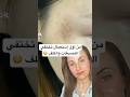من أول استعمال تختفي التصبغات والكلف نصائح تجميلية   كلف علاج الكلف