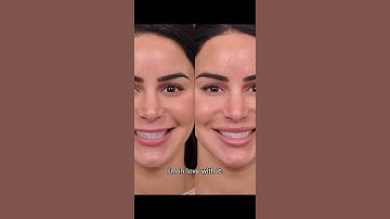 Lip Lift Journey: Day 1 ➡️ 4 Months