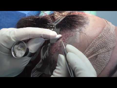Transplantacija kose komplikacije - Dr. Gorana Kuka