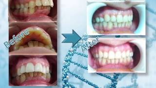 العلاج التقويمي للبروز الشديد في الأسنان العلوية     Orthodontic treatment of severe protrusion