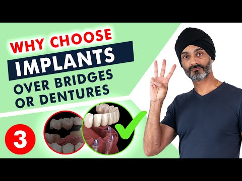 Dental Implant Vs Dental Bridge, what's better?