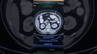 Cect w/abd appendix retrocecal position and dilated #@3DRadiologystudy #shorts #friendship