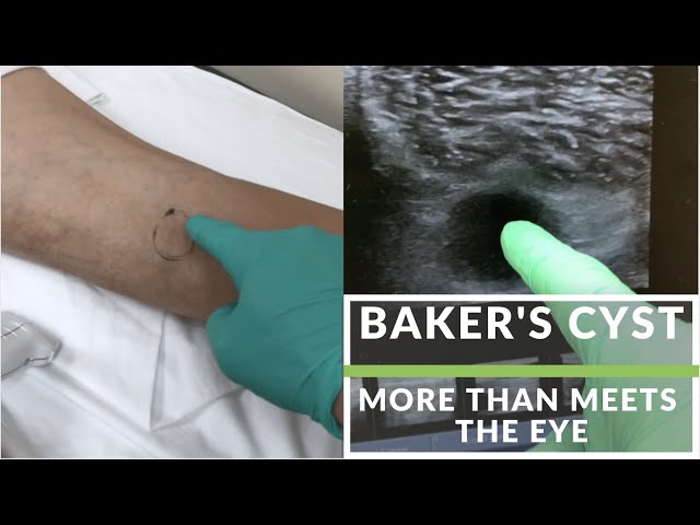 Baker's Cyst. More than meets the eye.