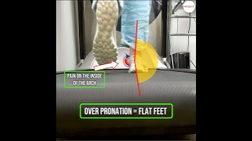 How Overpronation causes flat feet.