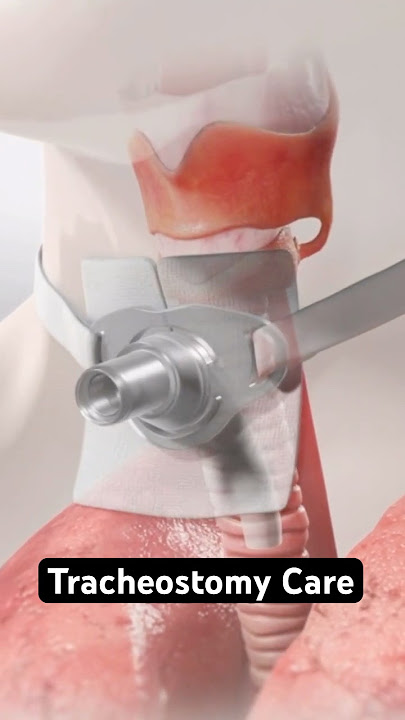 Tracheostomy Care (3D Animation)