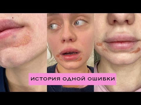 УВЕЛИЧЕНИЕ ГУБ. МОЙ УЖАСНЫЙ ОПЫТ. ВСЯ ПРАВДА