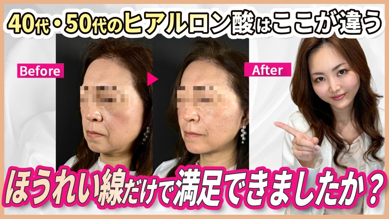 年齢でヒアルロン酸は変わる？20代と40代・50代の打ち方の違い、教え