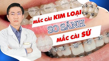 So Sánh Mắc Cài Sứ Với Mắc Cài Kim Loại | Nam Bùi Vinalign