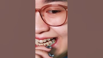 Đeo thun liên hàm sẽ như thế nào | Nha Khoa Khắc Ghi #shorts #youtubeshorts