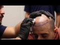 Chris Lopez Changes Clients Life Through Scalp Micropigmentation in NYC