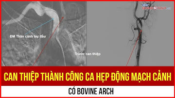 Can thiệp thành công ca hẹp động mạch cảnh có Bovine Arch
