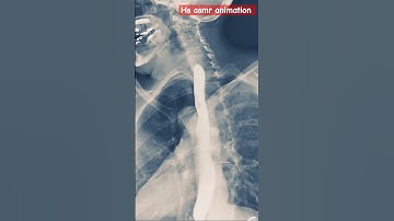 Dynamic X-Ray Retrospective View of the Esophagus inMotion | Konica Minolta Healthcare #emergency