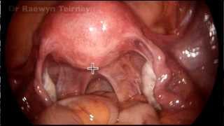 Normal female pelvis from a laparoscope by Dr Raewyn Teirney