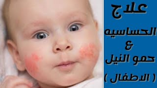 علاج الحساسيه فى الاطفال | علاج حمو النيل | allergy | كورس التدريب الصيدلى