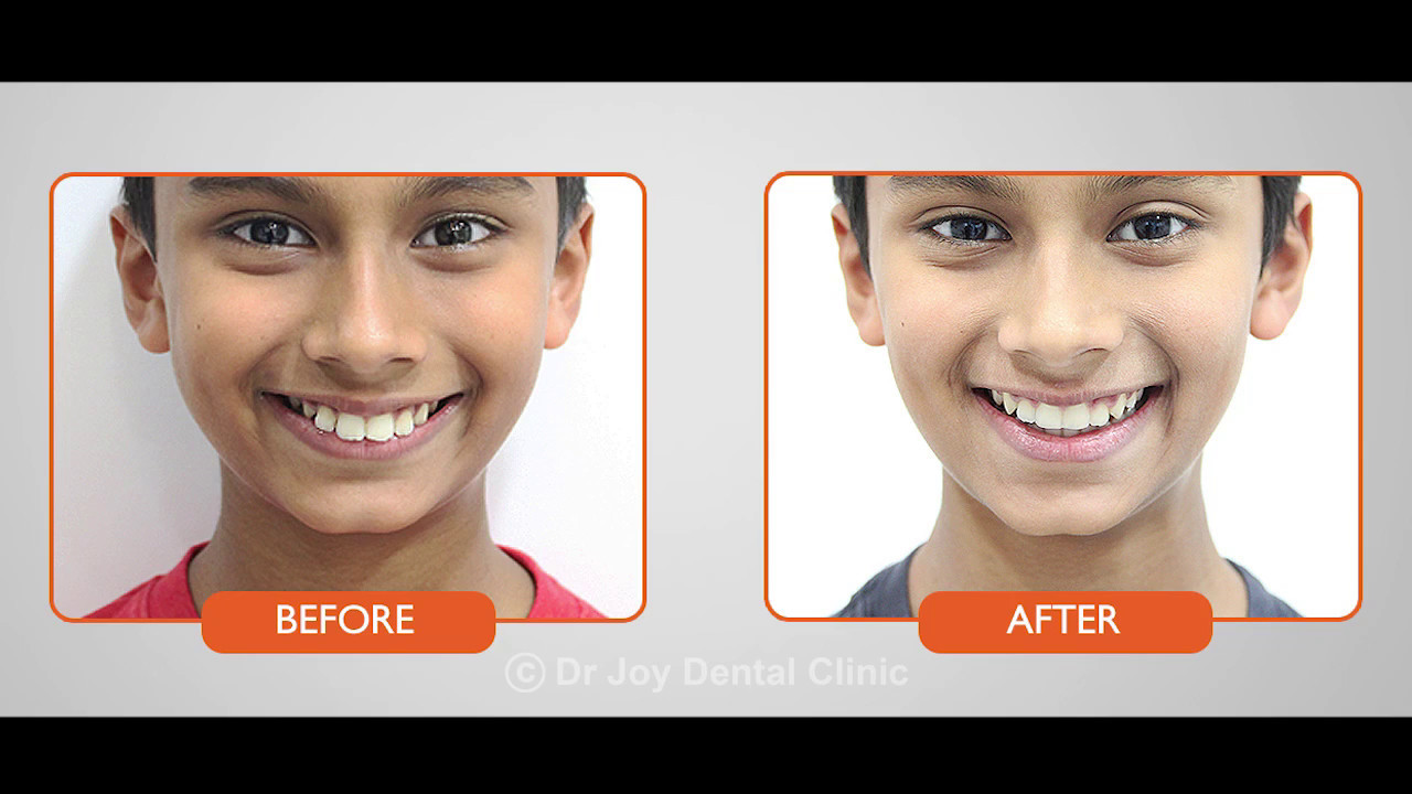Braces in Dubai Patient Testimonial Dr. Joy Dental Clinic Dubai