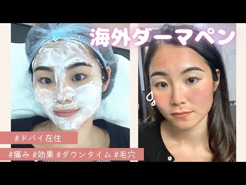 【ドバイ在住】海外のダーマペンダウンタイム1週間レビュー!ニキビ跡や毛穴に効果?!経過を詳しくご紹介します✈️