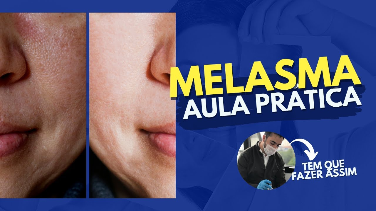 PROTOCOLO DE MELASMA COSMOBEAUTY VULCAN ICE YouTube