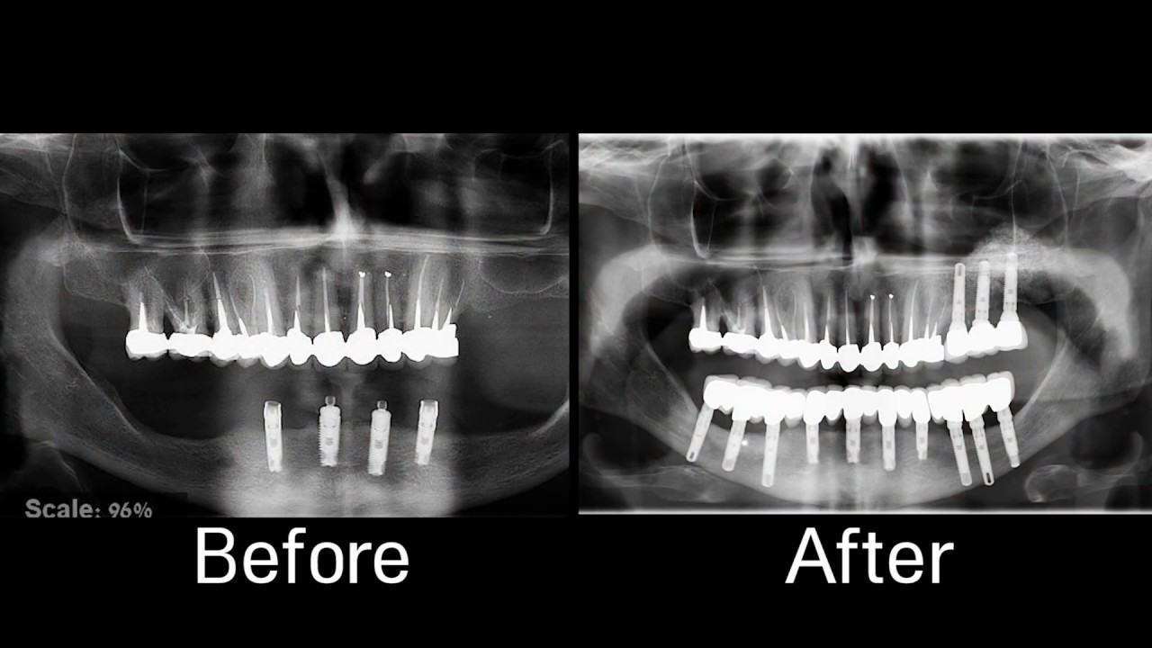 Inferior Alveolar Nerve Injury