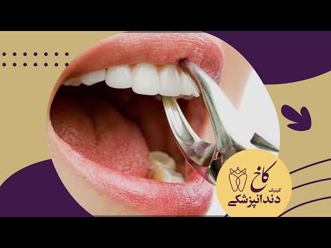 تصویری: چگونه بفهمیم نیاز به بستن بریس داریم؟