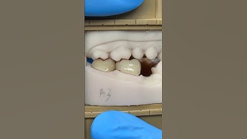 Great Occlusion with Two Amber Press Molars @HASSBIO #hassbio #hassambassador_kr #lsk121shorts