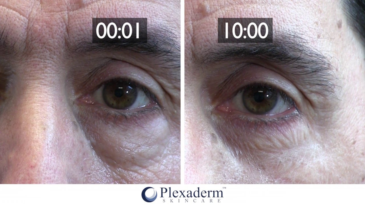 The Heavy Bags Under Ritchie S Eyes Nearly Disappeared In Just 10 Minutes With Plexaderm Removing Bags Under Eyes Wrinkle Remover Skin Care [ 720 x 1280 Pixel ]