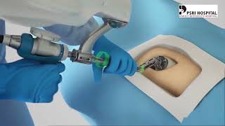 Mako Robotic Total Hip Replacement: How the Technology Works